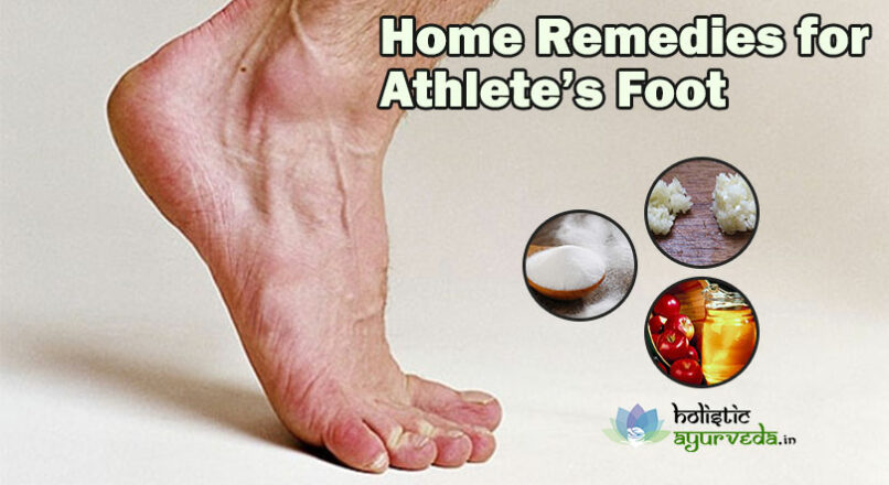 Home Remedies for Athlete’s Foot